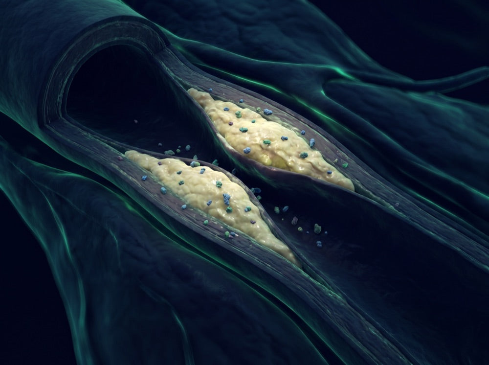 Arterial plaque